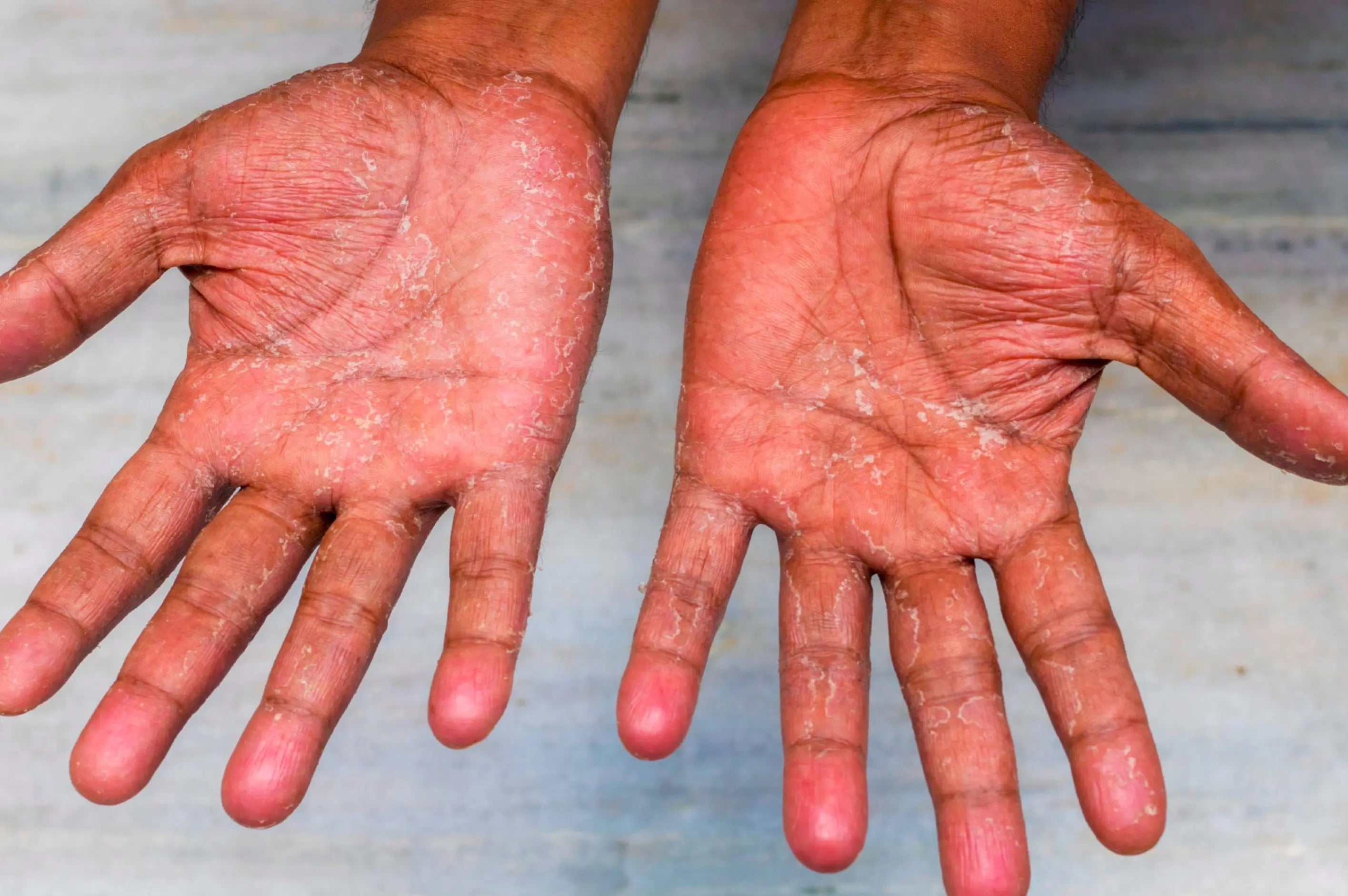 Corticosteroids Effective Treatment for Eczema? CUREZMA