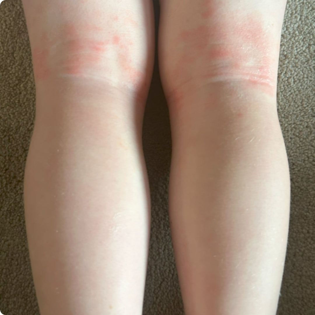 Eczema cream before and afters