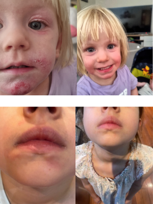 Eczema cream results