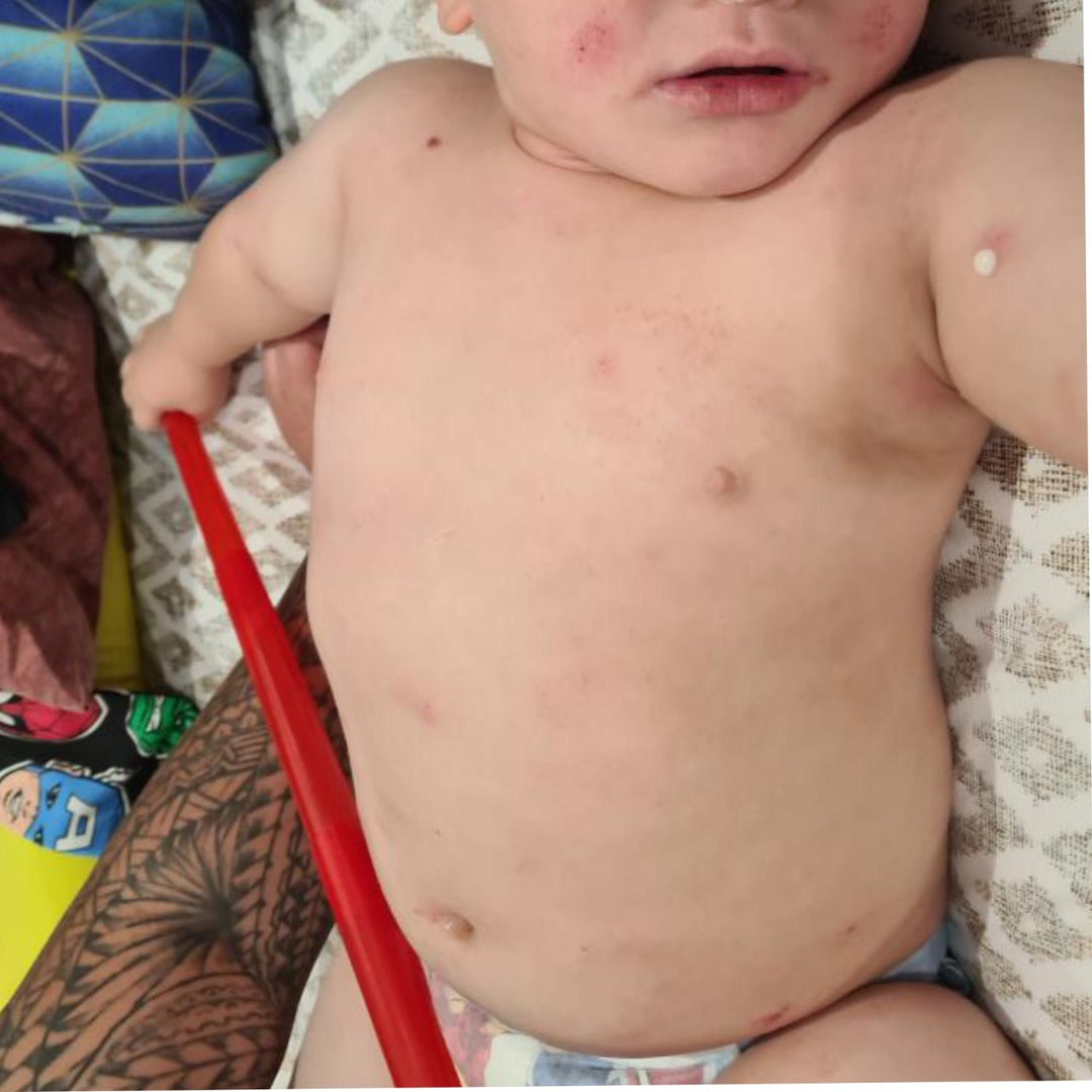 severe eczema