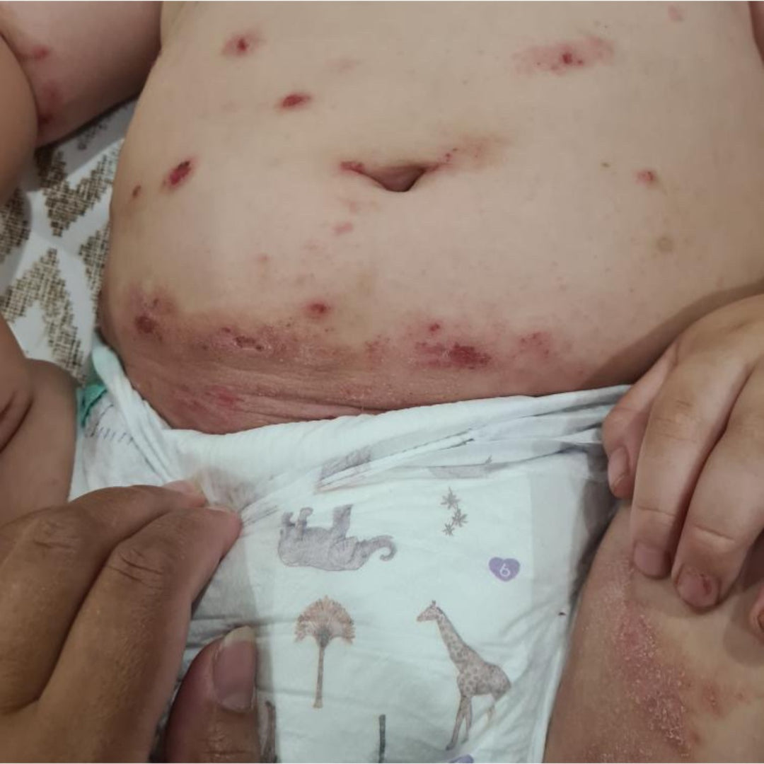 Severe Eczema