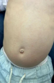 Steroid Free Eczema Solution
