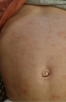 Steroid Free Eczema Solution