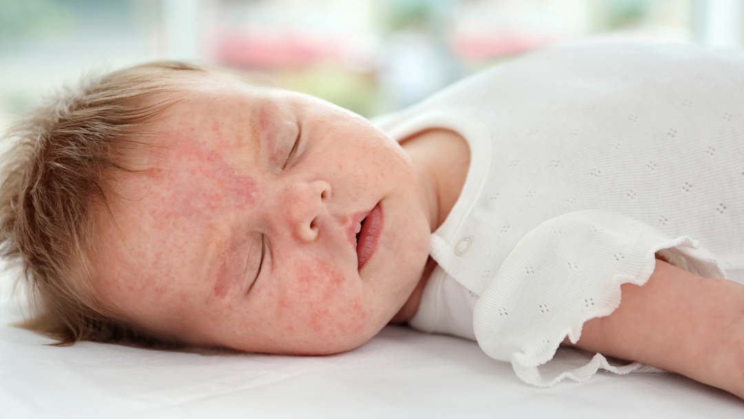 newborn eczema on face