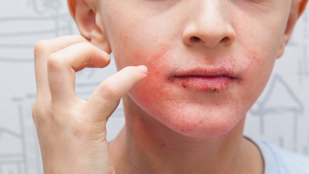 Lip eczema