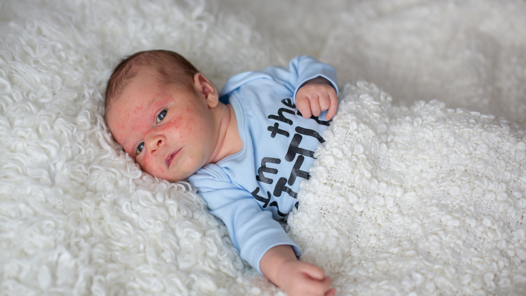 Newborn with eczema flare up