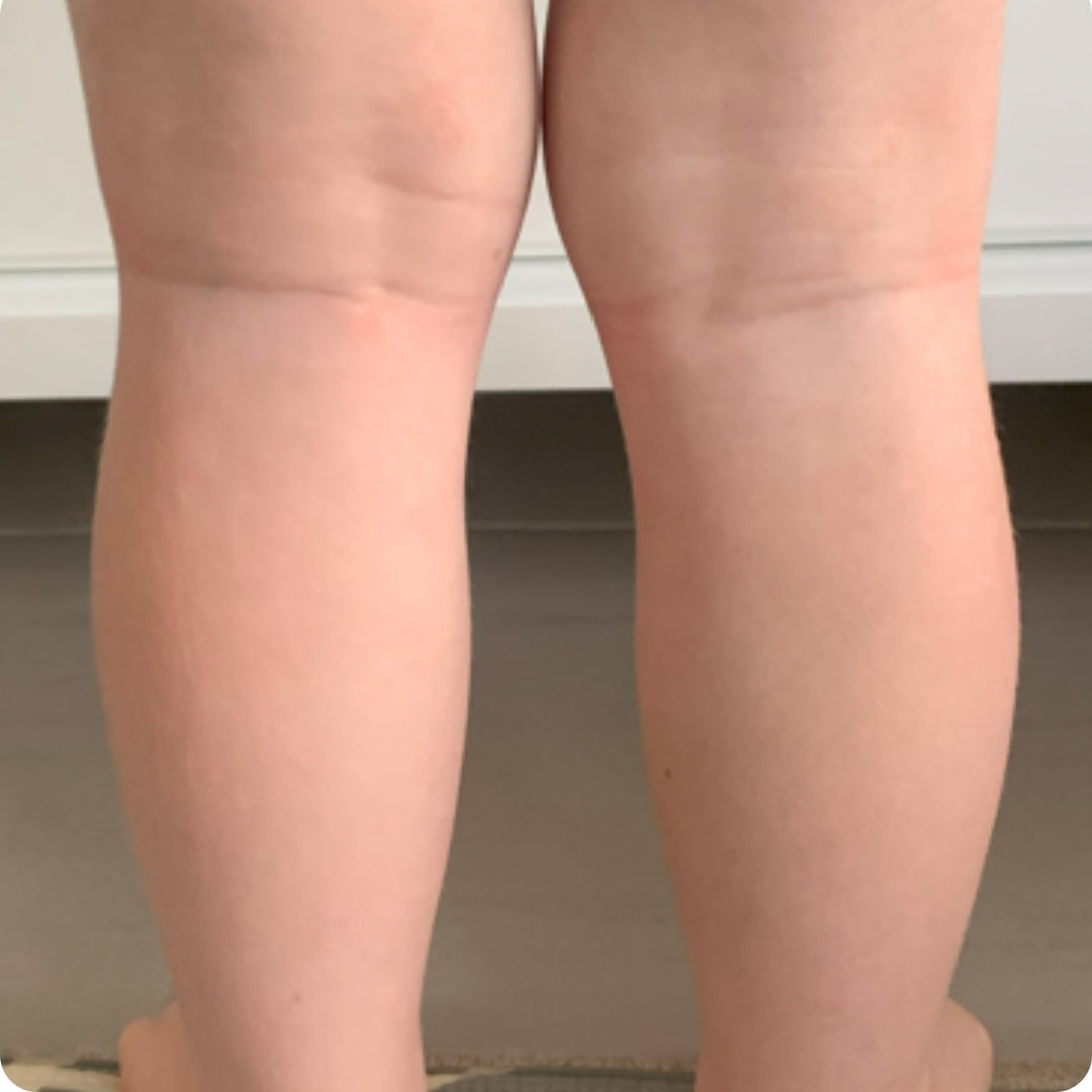 Eczema cream before and afters