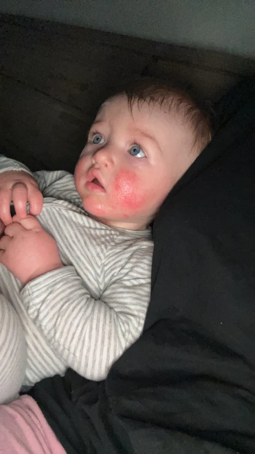 Eczema rash on face