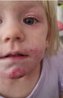 dermatitis eczema